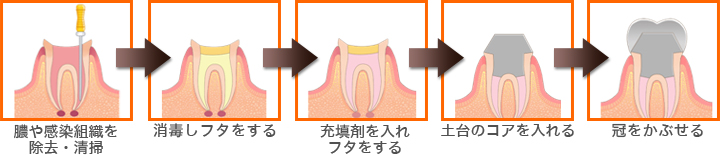 歯根膜炎の場合