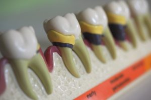 歯周病の模型